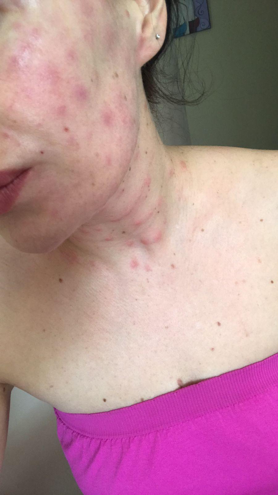 Фото «Будто кипяток под кожей»: жительница Новосибирска получила отёк Квинке после процедуры у косметолога на дому 5